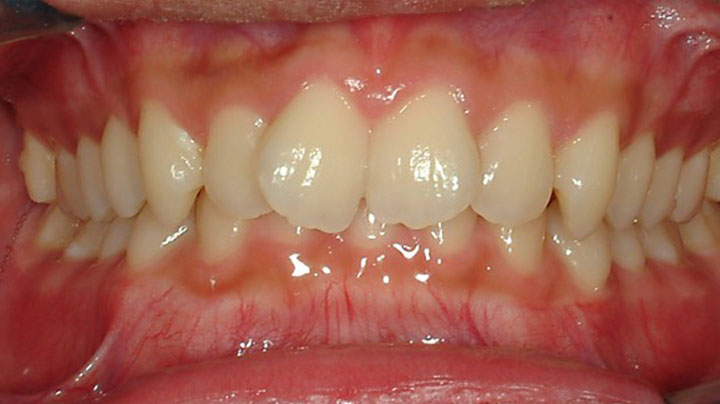 A smile of a patient after braces treatment at Picasso Dental Care.