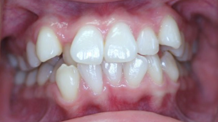 A smile of a patient with before braces at Picasso Dental Care.