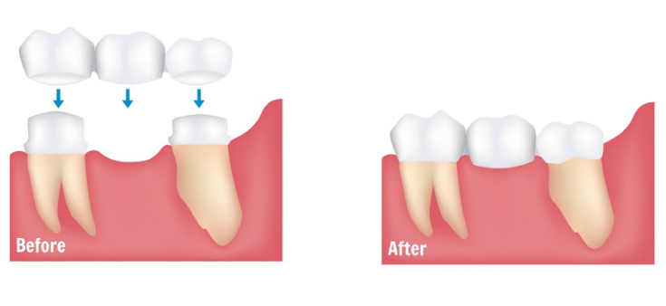 Diagram of missing teeth and bridge replacing missing teeth.