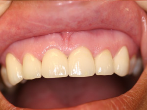 Case 2 of a after before crown