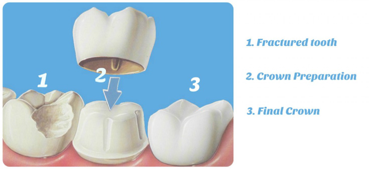 Stages of crown's placement.