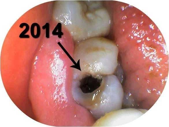 Small cavity expanding to larger one in just 2 years at Picasso Dental Care.