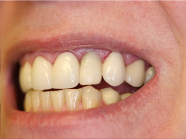A smile of a woman after the missing tooth was replaced.