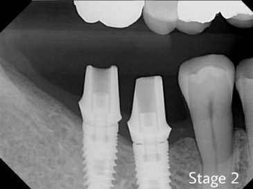 Stage 2 of dental implants