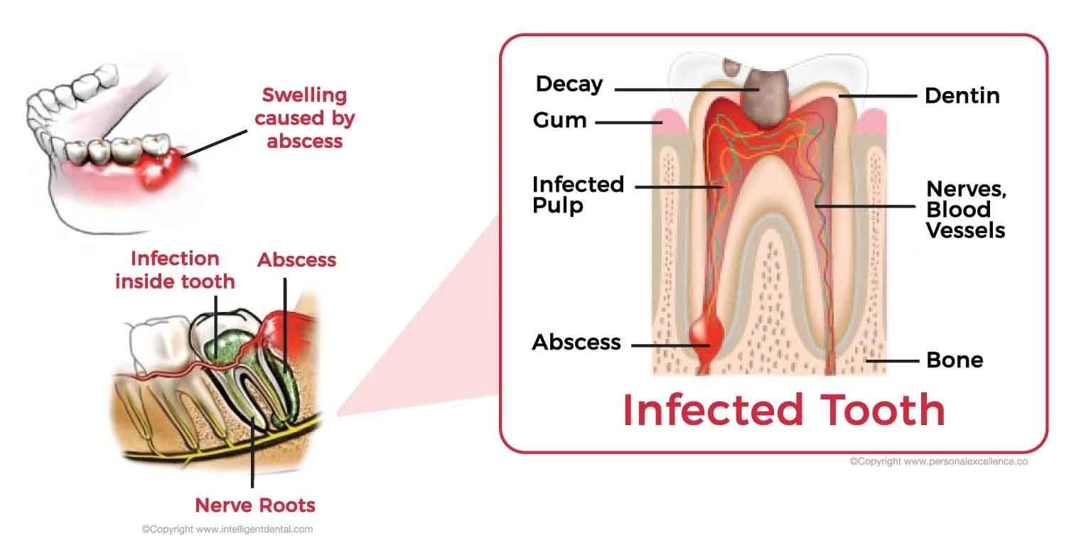 A diagram of  stages in which decay occurs with a teeth.