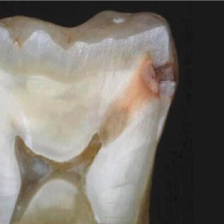 Tooth showing early signs of decay.