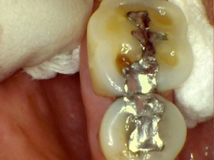 Case of failing dental work, where tooth around metal filling is starting to erode.