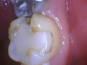 A failing. dental work exmaple, where tooth with a filling is forming cavity in one corner.