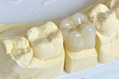 realistic model of 4 teeth, one with a porcelain crown