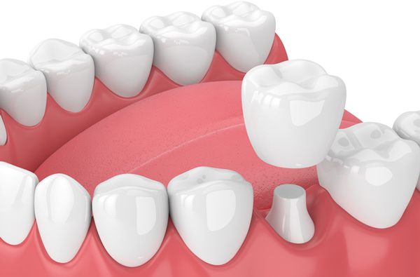 Rendering of jaw with dental crown at Picasso Dental Care