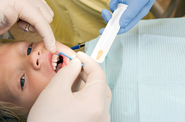 Young boy receiving fluoride treatment at Picasso Dental Care in Temecula, CA