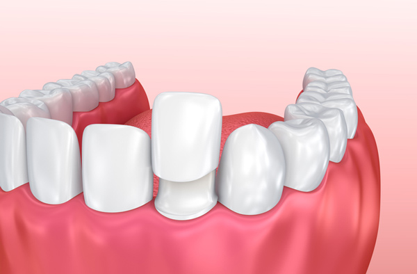 Rendering of jaw with porcelain veneer on tooth