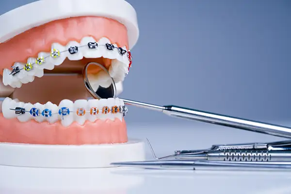 Orthodontic model and dentist tool demonstrating the varieties of orthodontic bracket or brace.
